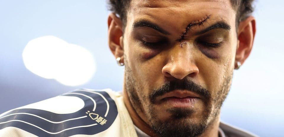 Athlete with stitches and bruising on face