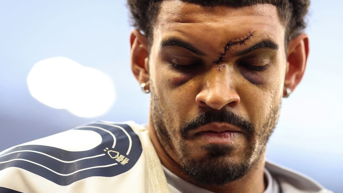 Athlete with stitches and bruising on face Athlete with stitches and bruising on face
